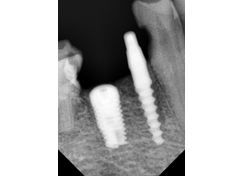 implant2