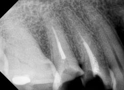 Root Canal Treatment