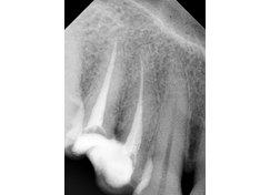 root-canal